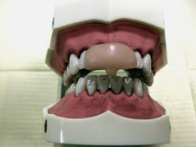 摂津市歯科/マウスピース/歯ぎしり