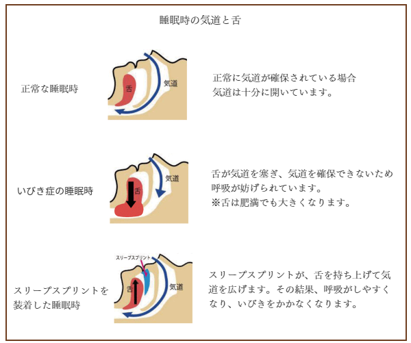 摂津市歯科/スリープスプリント/小坂歯科医院